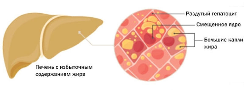 Жировая печень симптомы лечение у женщин. Неалкогольный жировой гепатоз печени. Гепатоза печени не алкогольный. Жировой гепатоз стадии. Неалкогольный стеатоз печени.